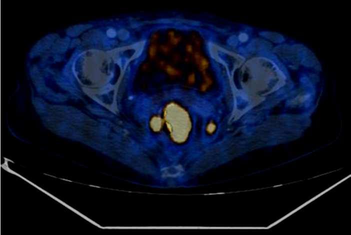 Biopsie 01/2007: kein Anhalt für Filiae PET / CT zum Restaging des