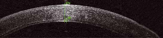 Thannhäuser, Pham: Sechs Jahre Erfahrung mit DSAEK eine Standortbestimmung Abb. 5: Darstellung einer ultradünnen Excimer-DSAEK 8 Wochen postoperativ.