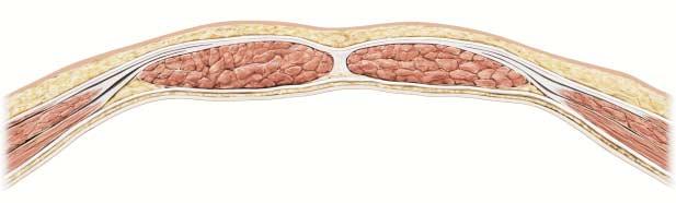 .5 Bauchwand 135 ist hier nur von der dünnen inneren Bauchfaszie (Fascia transversalis) und dem Peritoneum bedeckt.