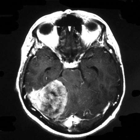 Vp 115 Alter: 66 Jahre Geschlecht: weiblich Händigkeit: rechts Untersuchungszeitpunkt: präoperativ Diagnose: Meningeom Größe: 5 x 5 x 5 cm,