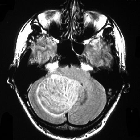 Vp 116 Alter: 36 Jahre Geschlecht: männlich Händigkeit: Ambidexter Untersuchungszeitpunkt: postoperativ Diagnose: Gangliozytom (WHO I) Größe: 6 x