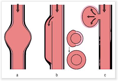 Aortenaneurysma Aneurysma: Umschriebene oder diffuse Erweiterung der Aorta > 30 mm; Ektasie: 25 mm bis 30 mm a) A. verum - spindelförmig - sackförmig b) A. dissecans (in normal weitem Gefäßlumen mögl.