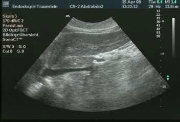 Atemvariabilität Vena cava Das Pfortadersystem Zusammenfluß von V.mes. Inf. und V.