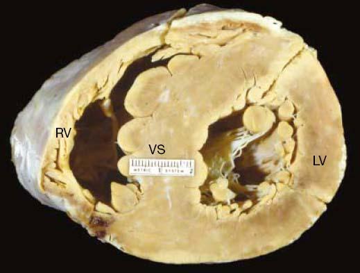 14 Abbildung 3: Humanes Herz mit Zeichen kardialer Hypertrophie bei hypertropher Kardiomyopathie mit deutlich verdicktem Septum (VS) bei nur geringfügig hypertrophiertem linken Ventrikel (LV) (nach
