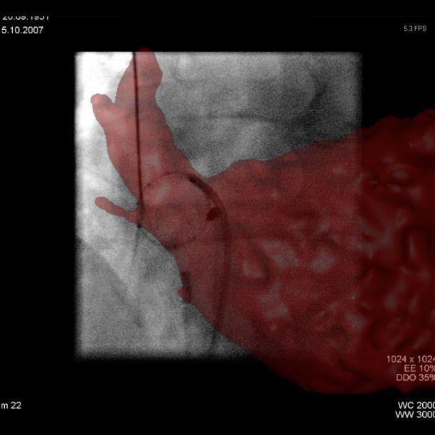 ROPV LA Abbildung 8: Integration des segmentierten linken Vorhofs (LA) und der rechten oberen Pulmonalvene (ROPV), welches über eine dreidimensionale Rotationsangiographie (Syngo DynaCT Cardiac,
