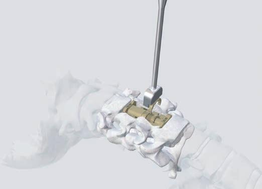 7 Implantat mit Verriegelungsklammer sichern Benötigtes Instrument 397.