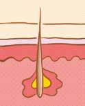 Wie die Akne entsteht 09 Bei der Entstehung der Akne spielen viele Gründe eine Rolle. Oft ist eine Neigung zu unreiner Haut vererbt worden.