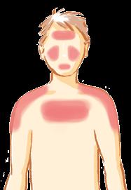 Oft sind auch die Schultern, der Brustbereich und das Dekolleté, der obere Rücken und die seitlichen Abschnitte der Oberarme betroffen.