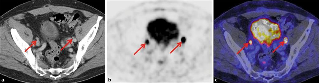Samenblase. Diese wurde anschließend histologisch gesichert und ergab ein Rezidiv eines Prostatakarzinoms Gleason-Score 7. a CT mit KM.b PSMA-PET Bild.c Fusioniertes PSMA-PET/CT Bild.