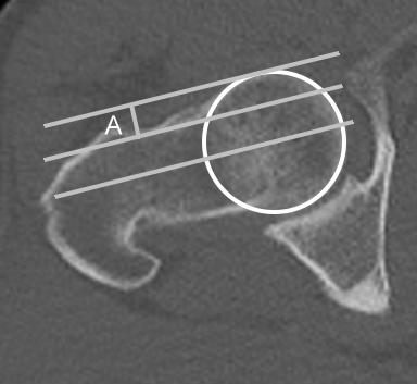 Abbildung 9: Head-to-Neck-Offset in axialer Schichtung (Eigene Darstellung) 2.3.1.