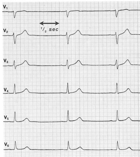 Aussehen im EKG 1.1.5.