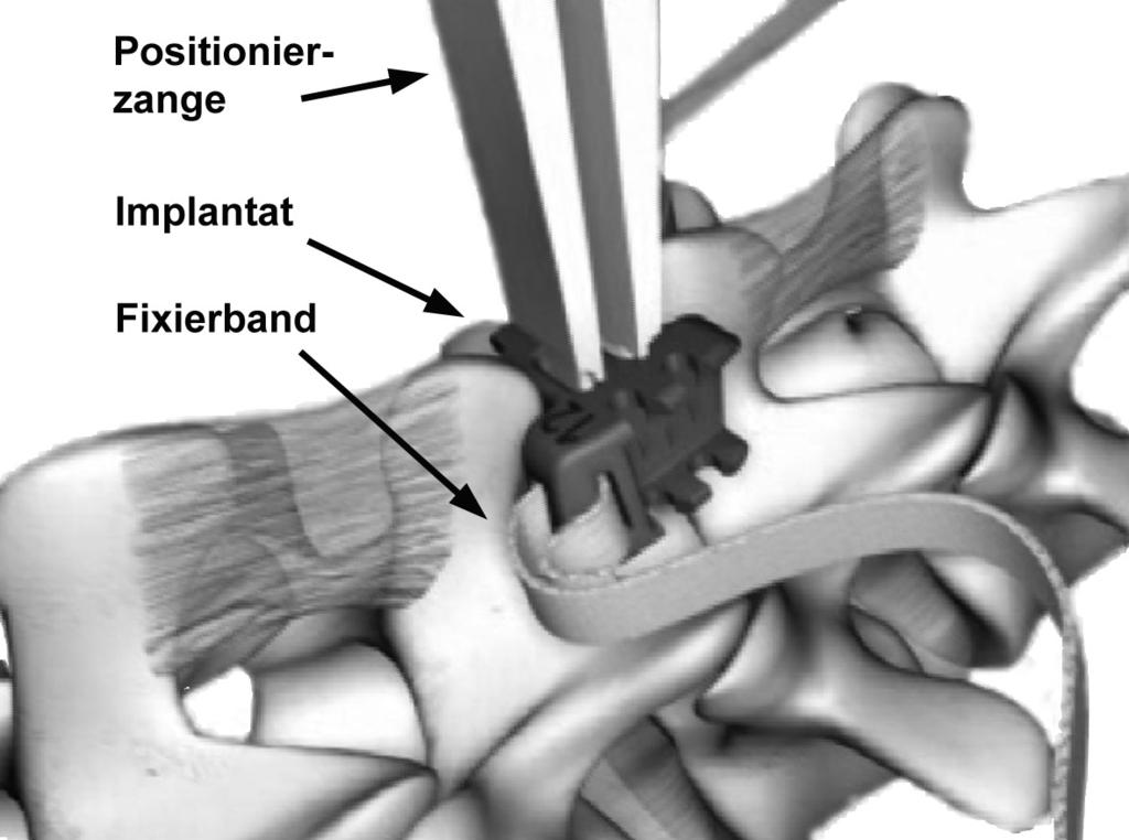 24 2.3. Operatives Vorgehen Nach der üblichen Vorbereitung und erfolgtem Hautschnitt wird die Faszie über dem Ligamentum supraspinale geteilt und das Ligamentum supraspinale freigelegt.
