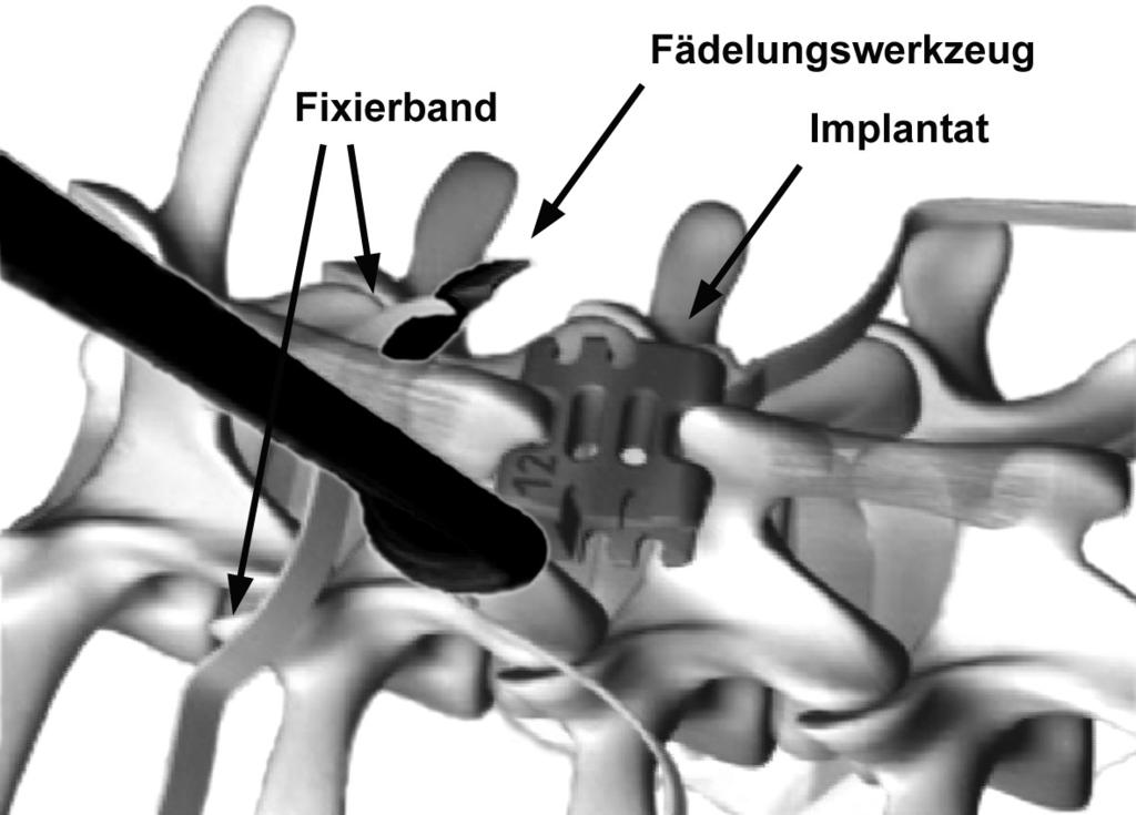 25 Mit einem weiteren Spezialwerkzeug (Fädelungswerkzeug) werden nun die Fixierbänder des Wallis-Implantats durch die jeweiligen Ligamenti interspinale der benachbarten Dornfortsatzzwischenräume