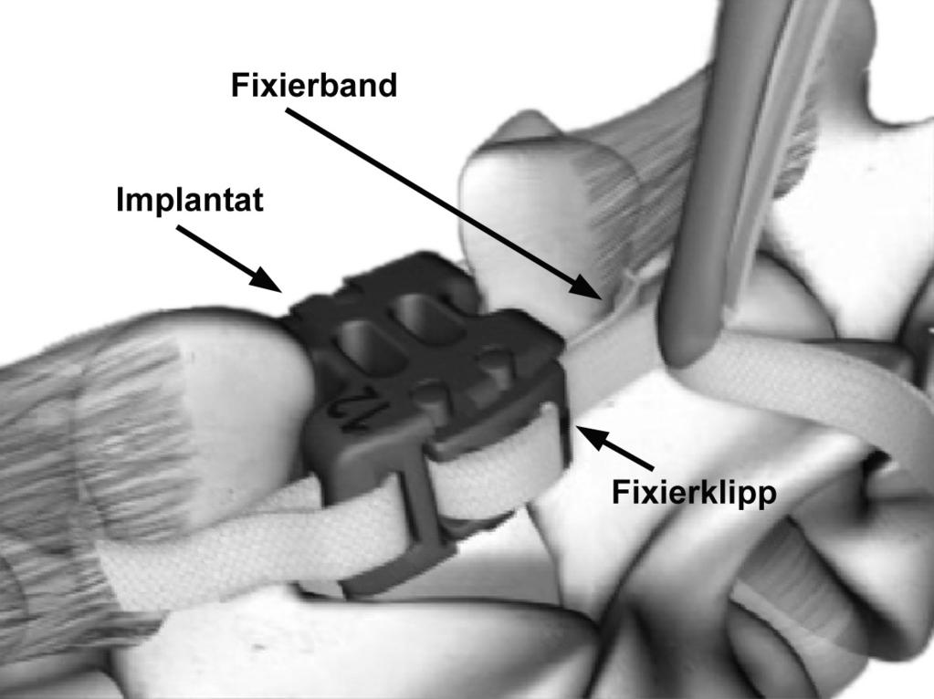 Implantat eingerastet. Abb. 8: Das eingesetzte Implantat wird durch Fixierbänder in seiner Position gehalten.