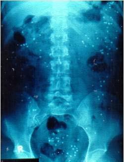 Bei der neu aufgetretenen Obstipation werden häufig auch eine Ultraschalluntersuchung des Bauchraums und ggf. Röntgenaufnahmen angefertigt.