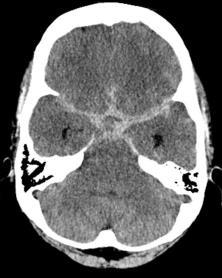 temporalis Lageabhängigkeit? Veränderung im Verlauf! Alter des Patienten! Therapie?