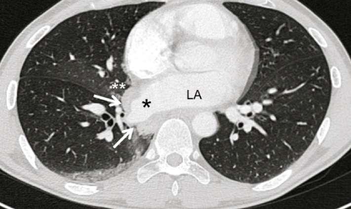 Abbildung 5 c: Angiographie der rechten unteren Pulmonalvene (Stern), Panel C Repräsentativer Brust CT-Scan, auf dem eine zirkuläre Hämorrhagie (Pfeile) neben dem Vorhof der rechten unteren