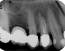 Endodontologen erst in den Kinderschuhen. Röntgenbilder sind die Visitenkarten des Endodontologen.