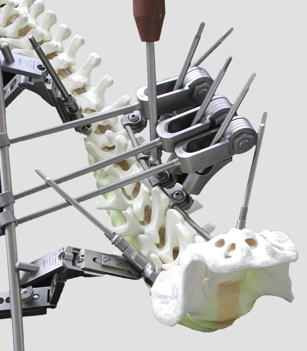 Dauerhafte Fixation und Spondylodese Permanent fixation and spondylodesis Prior to the assembly of the krypton rods, laminae and spinous processes are carefully decorticated and finecrumbed