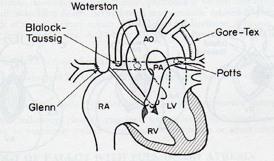 Einleitung Auch die Pott- Anastomose, welche eine Verbindung der deszendierenden Aorta mit der linken Pulmonalaterie darstellte, ist heutzutage, aufgrund der häufig resultierenden Herzinsuffizienz