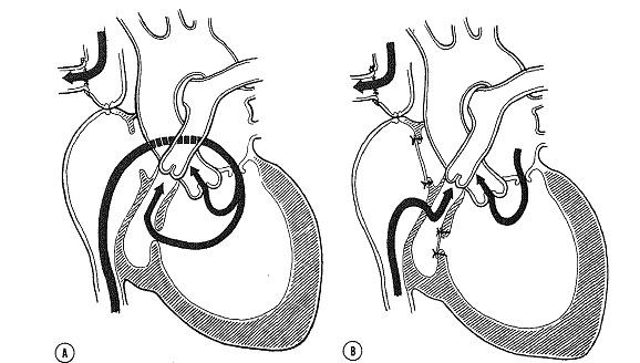 Einleitung Abb. 1.6: Operation nach Kreutzer (63) 1979 entwickelten Björk at al eine Technik, bei welcher der hypoplastische rechte Ventrikel in den Lungenkreislauf miteinbezogen wird.