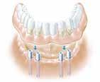 Der Silikonanteil, der an den Implantatpositionen perforiert ist, stellt das Zahnfleisch des Patienten dar.
