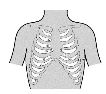Material und Methode Abb.3 EKG-Ableitung nach Wilson Alle angegebenen Ableitungspunkte gelten für Erwachsene und Kinder mit Ausnahme des ersten Lebensjahres.