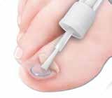 Harnstoffsalben zur Entfernung des betroffenen Nagelmaterials werden in der Regel einmal täglich dick auf den gesamten betroffen Nagel aufgetragen und mit einem Pflaster abgedeckt (Abb. 15).