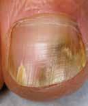 1.7 Symptome und typischer Verlauf einer Nagelmykose In den meisten Fällen dringt der Pilz am distalen Ende unter und seitlich des Nagelrandes in den Nagel ein und wandert an der Unterseite der