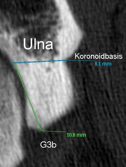 Hounsfield-Units Ergebnisse Die Messlinie G3b verläuft von der Koronoidspitze als Tangente der Incisura radialis an die gelenknahe Koronoidbasis.