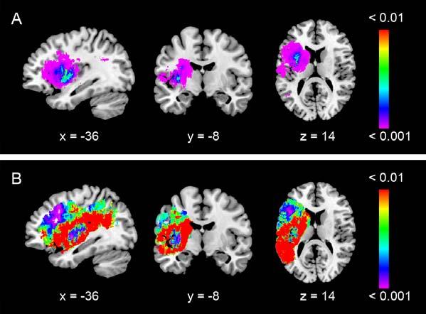 Supplementary Information (SI): Damage to ventral and dorsal language pathways in acute aphasia SI-Figure 1: Distribution of voxels related to impairments of repetition and comprehension SI-Figure 1: