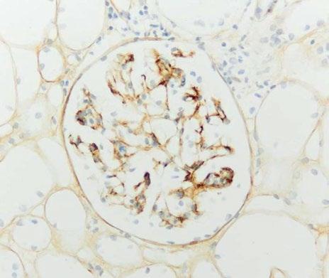 .3 Purpura Schönlein-Henoch Nephritis und IgA-Nephritis 79 Tab..6 Definition der pathologischen Variablen der Oxford-Klassifikation der IgA-GN (Mod.