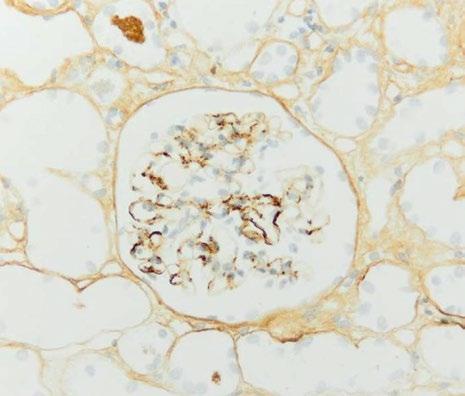 Mesangialzellen/Mesangiumfeld = 3 M0 0,5 M1>0,5 a Segmentale Glomerulosklerose Endokapilläre Hyperzellularität Tubulusatrophie/interstitielle Fibrose Jegliche Sklerose, die nicht das ganze