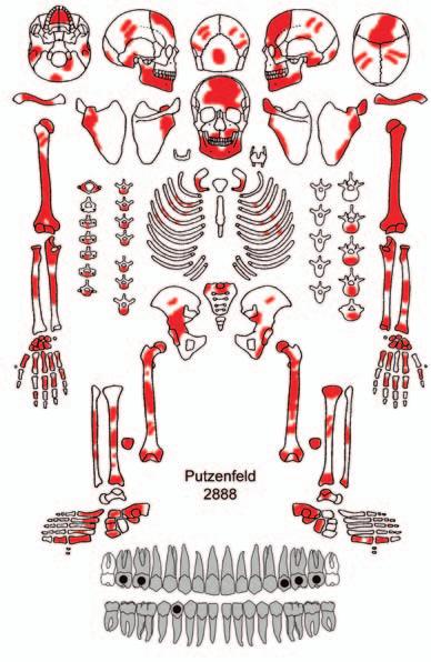 2 (links oben): Erhaltene Knochen und Zähne Individuum Putzenfeld