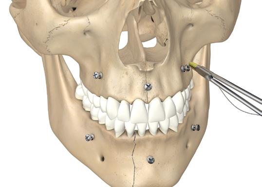 Anbringen der Drähte Die Drähte werden durch die Löcher in den maxillären und den gegenüberliegenden mandibulären Schrauben geführt.