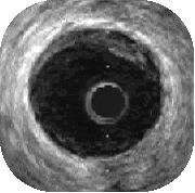 Abbildung 4. Intravaskuläres Ultraschallbild einer gering (zwischen 9 und 3 Uhr) veränderten Koronararterie.