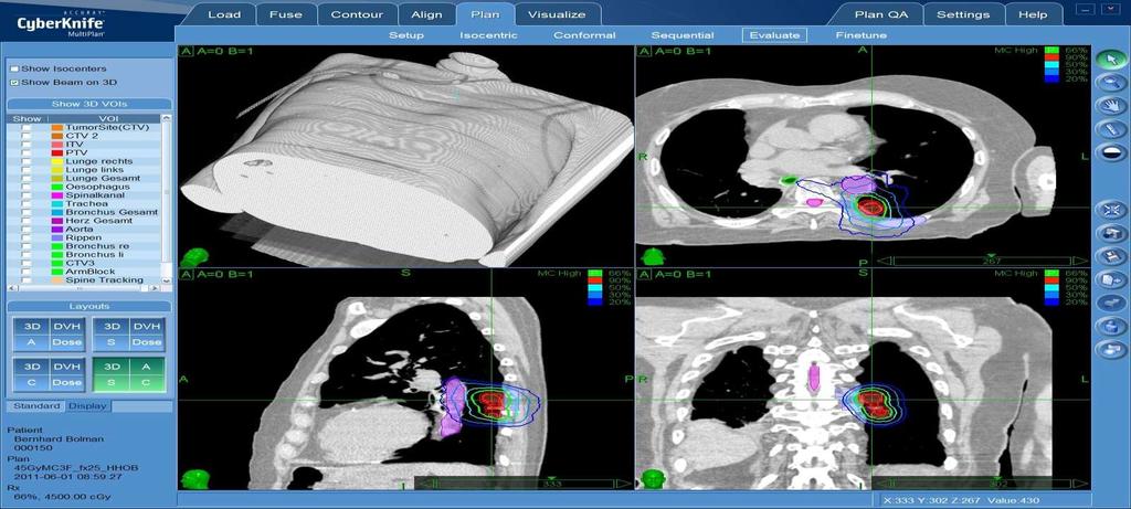 Lungenmetastase Vol: 2,4cc Patient inoperable und mit Atemgerät