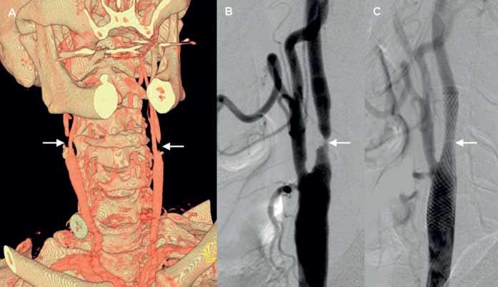 Die stentgeschützte perkutante Transluminale Angioplastie (PTA) bei Patienten mit symptomatischen extrakraniellen Stenosen der A.