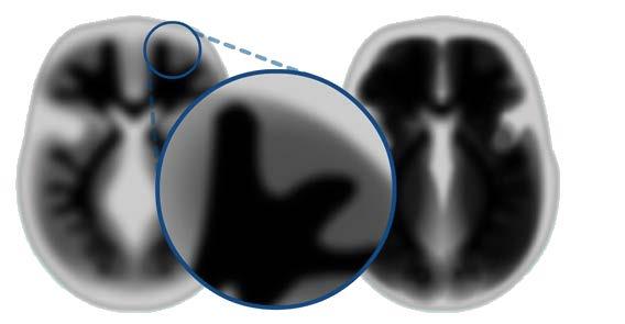 WIEDERGABE VON AMYVID-PET-SCANS IN EINEM NORMALEN GEHIRN UND EINEM GEHIRN MIT BETA-AMYLOID-PATHOLOGIE (FORTSETZUNG) Beim normalen Gehirn