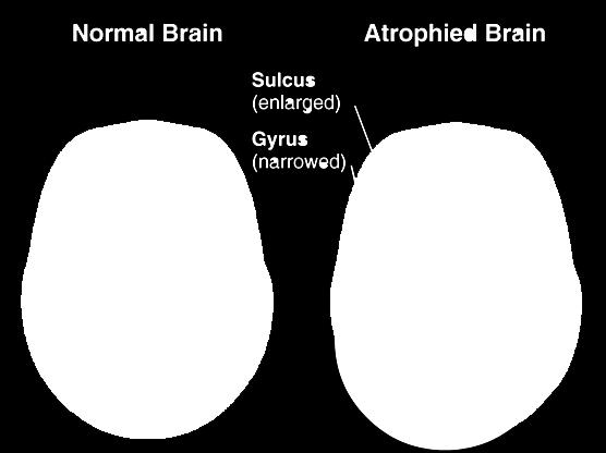 sich Gyri verengen sich Normales Gehirn Sulkus (vergrößert) Gyrus
