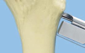 5 Bevor mit der Osteotomie begonnen wird, durch einen Rückschlag mit dem Schlitzhammer sicherstellen, dass der Meissel leicht gelöst wird.