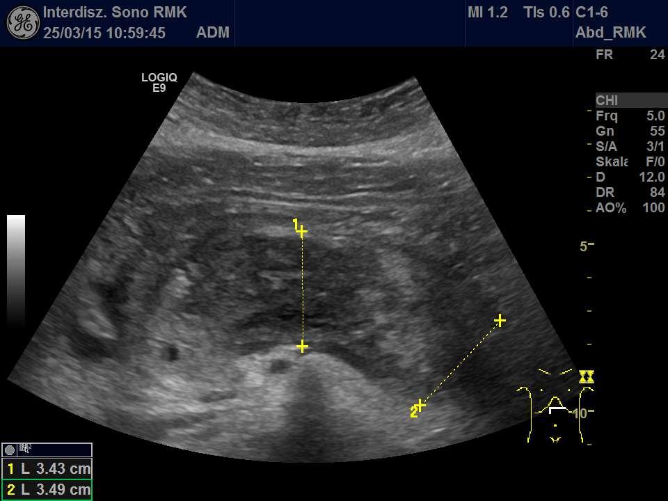 AKUTE PANCREATITIS