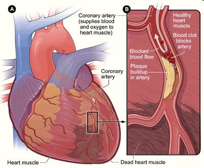 Koronare Herzkrankheit "Koronare Herzkrankheit" ist der Oberbegriff für Krankheitsbilder, die durch eine Mangeldurchblutung (Ischämie) der Herzkranzarterien hervorgerufen werden und deren Ursache