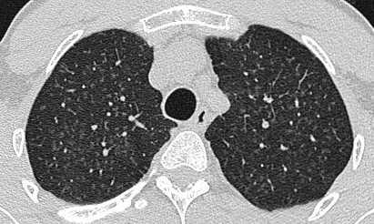 52 In 15,9 % (N=7) fanden sich in der HRCT-Untersuchung der Lunge Hinweise auf eine Alveolitis, die nach Art und Verteilung der Befunde denjenigen bei Al- Pulverarbeitern entsprachen (siehe Abb. 2.