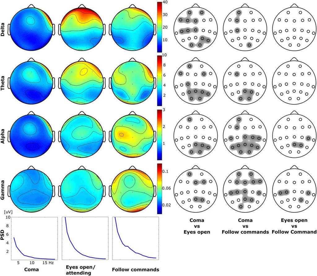 Quantitatives EEG differenziert zwischen