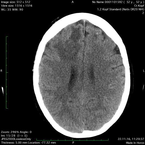 Zusammenfassung 3x endovaskuläre Therapie (1x Ballon-Dilatation, 2x Nimotop diskontinuierlich) Relevanter