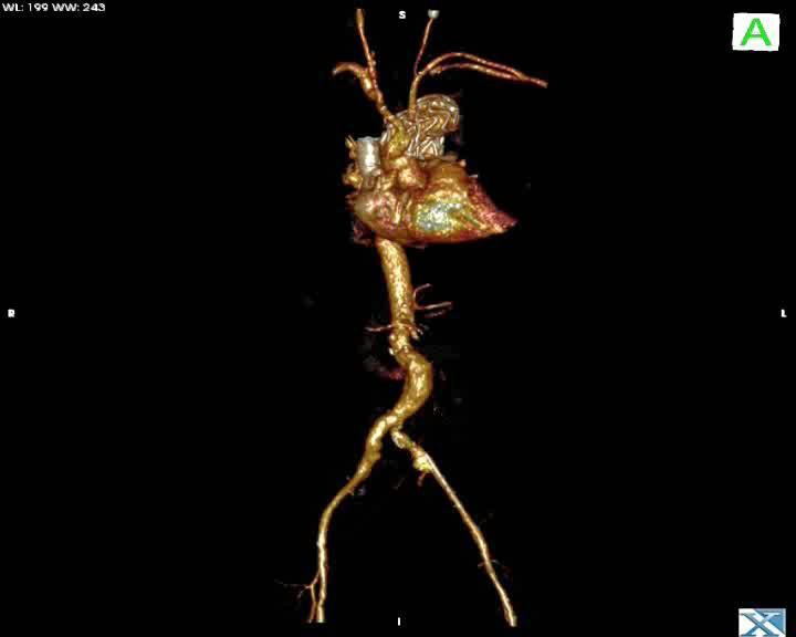 3D Darstellung Herz, Hauptschlagader und angrenzende Gefässe Quelle: Dr.