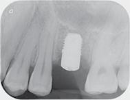 1: Präoperatives periapikales Röntgenbild zeigt fehlenden Zahn 26. Abb.