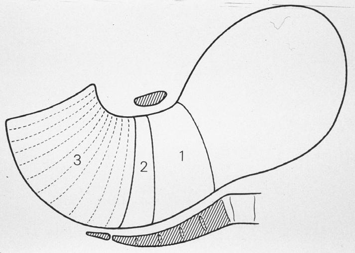 Weichteilschlauch unteres Uterinsegment (1) unterer