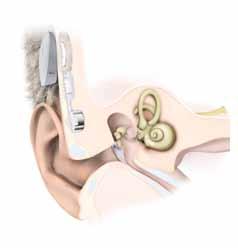 Hörimplantat optimales Verstehen trotz hörbeeinträchtigung In der Implantologie von Hörhilfen zählt die HNO-Abteilung am Klinikum Wels-Grieskirchen zu den Vorreitern in Österreich.